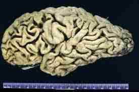 La perte progressive des capacités mentales et l`altération de la capacité à exercer une activité motrice entraînent la mort du sujet dans les six mois. La Maladie De Creutzfeld Jakob Savoir Fr