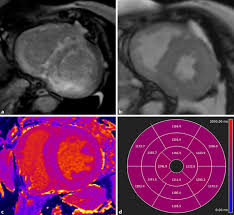 Journal of the american college of cardiology vol. Cardiac Mri Update 2020 Springerlink