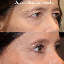 Yay 😊 Another happy patient 🥰. So exciting to see our work make people  feel better and look amazing! Here we did in office upper blepharoplasty.  30 min and done. You can