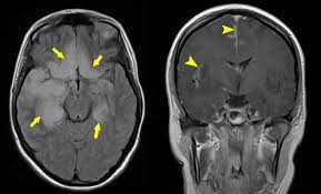 Hsv encephalitis causes inflammation, hemorrhage and edema. Encephalitis Ct Scan Radiopaedia Ct Scan Machine