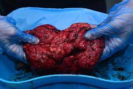 This is the usual type seen in humans. Plazenta Brauche Rund Um Den Mutterkuchen Hebammenblog De