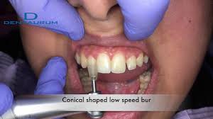 If you make a purchase after clicking on a link i may earn a small in this article, we examine several methods you can use at home in order to get rid of the yellow or brown stains. Ff002 Composite Residue Removal Braces Glue On Teeth After Braces Youtube