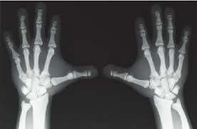 Maybe you would like to learn more about one of these? Ap X Ray Of Both Hands Demonstrate Short Stubby Fingers With Dysplastic Download Scientific Diagram