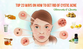 Top 23 Ways On How To Get Rid Of Cystic Acne Naturally Quickly Back Acne Treatment Acne Treatment Cystic Acne