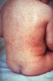 The rhinovirus is the most common viral infectious agent in humans and is the predominant cause of the common cold. Exanthem Wikipedia