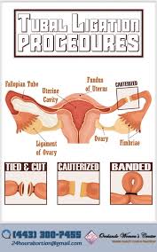 What Is Tubal Ligation Methods Birth Control Fallopian Tubes Birth Control Methods