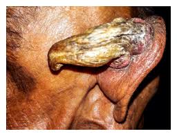 Image result for cornu cutaneum)