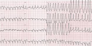 Image result for Ventricular Fibrillation Management in the Adult