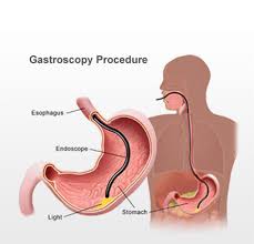This will allow the medicine to wear off. Gastroscopy Procedure Cape Town Dr Jacques Badenhorst
