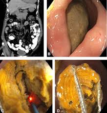 Extracorporeal Shock Wave Lithotripsy - Z Urology