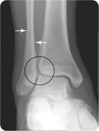 A line spiraling around the entire bone and a longitudinal line linking the proximal and distal portions of the spiral. Spiral Fractures Radiology Key