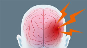 In several cases, external signs of head. Abbott Blood Test Can Detect Concussions That Ct Scans Missed Study Shows Biospace