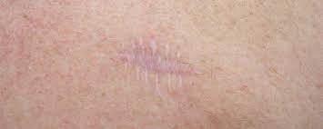 How To Reduce The Appearance Of Surgical Scars – Skin Repair