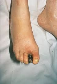 Image result for diabetic toes