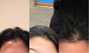 This is the type of hair loss that might become more pronounced with each pregnancy, says david salinger, director of the international association of trichologists. My Hair Is Thinning At Widows Peak Small Bald Spot Any Suggestions For Hair Growth Femalehairadvice
