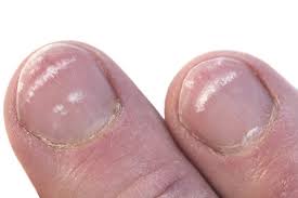 what causes white milk spots on nails