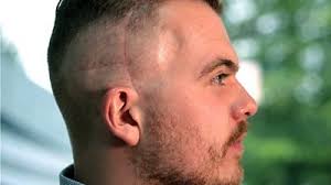 The other reason that the hair or scalp should be shampooed regularly is that, if you decide to wear a hat or wig, then the scalp has a covering of sebum (sweat) and this can leave the surface sore along with an odour. Cancer Patient Encourages Men To Talk About Hair Loss Bbc News