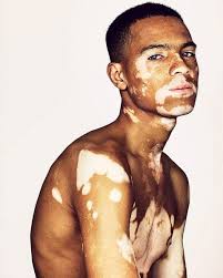 Pin By Lil Will On Rodache Vitiligo Model Vitiligo Portrait