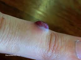 Image result for Pyogenic Granuloma