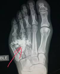 Damage may include bleeding, broken bones, organ damage, infection of the wound. Pin On X Rays