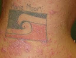 This is normally associated with reactions such as allergies to the tattoo ink (allergic reactions to ink can occur many years after getting a tattoo). Tattoo Associated Skin Reactions Dermnet Nz