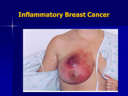 Inflammatory breast cancer is a rare but very aggressive type of breast cancer in which the cancer cells block the lymph vessels in the skin of the breast. Breast Cancer Tumor Board Ppt Video Online Download