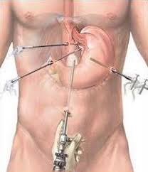 One Of The Surgeries For Correcting A Hiatal Hernia Natural Health Supplements Natural Health Health