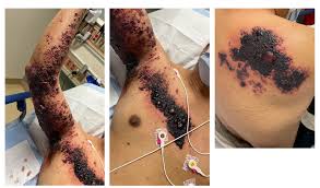 Image result for herpes zoster