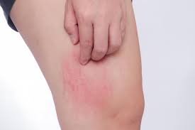 The problem of small itchy bumps on your skin can be caused due to various reasons regardless of your skin type. From Ticks To Spiders 11 Pictures Of Common Bug Bites And How To Spot Their Symptoms
