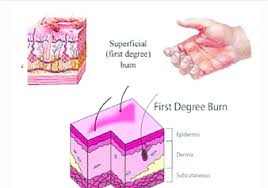 A first degree burn is extremely uncomfortable and begs immediate attention. First Degree Of Burn Download Scientific Diagram