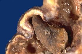 Large stones are in the ureter 4. Renal Pathology