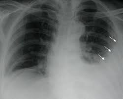 Contextual translation of talcage into english. Pleuresie Thoracoscopie Chirurgie Thoracique Hopital Bichat