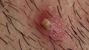 The earth has sprouted a pimple in new forest national park in hampshire, united kingdom. 25 Grossest Zit Popping Videos Of All Time Pimple Popping 2021