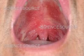 Image result for oral thrush symptoms roof of the mouth