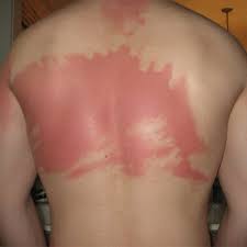 We'll use a cookie to save getting sunburnt can increase your chance of getting skin cancer. What Happens To Your Skin When You Get Sunburnt Cancer Council