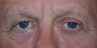 One uniformly recommended treatment for bell's palsy is protecting the eye from drying at night or while working at a computer. Bell S Palsy Treated With Facial Nerve Decompression