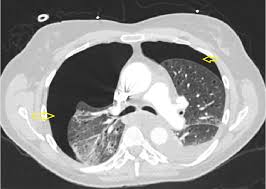 Ct scan of the chest showing a pneumothorax on the person's left side (right side on the image). Cureus Primary Pulmonary Epithelioid Angiosarcoma A Rare Case Presentation Of Bilateral Pneumothoraces