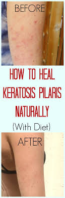 Using creams that have lactic acid is a great remedy to get rid of the red bumps on your arms. How To Heal Keratosis Pilaris With Diet Pure And Simple Nourishment