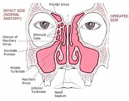 Endoscopic Sinus Surgery Picture Of Functional Endoscopic Sinus Surgery Click To Enlarge Sinus Surgery Sinusitis Sinus Allergies
