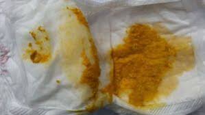 Image result for Allergic Colitis of Infancy