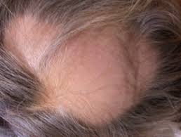 If you stand on your head you'll increase circulation, stimulating hair growth. Alopecia Areata Dermnet Nz