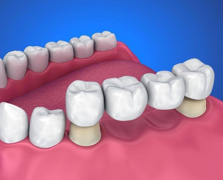 BRIDGES product image