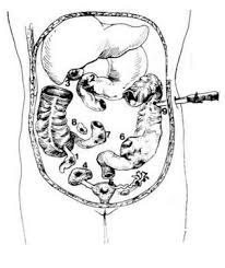 Dell'utero o degli annessi peritonite classificazioni   acuta: Http Chirurgiagenerala Ro Download Cursuri Peritonitele Pdf