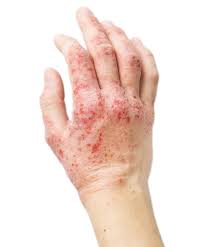 Teruk gila lepastu busuk tak. Eczema Treatment Malaysia Leading Skin And Aesthetic Clinic In Malaysia