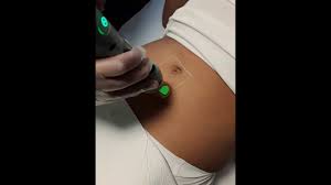 A video of me getting laser hair removal treatment on my lower abdomen. Laser Remedy Hair Removal Abdomen Trail Youtube