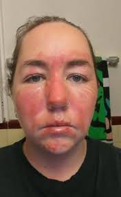I'll try to think of more later. Woman Photos Show The Healing Process Of Second Degree Burns