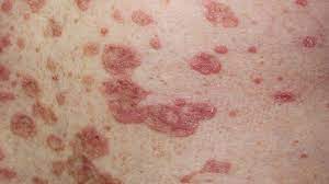 About half of all lupus patients experience a characteristic rash called the malar or butterfly rash. How To Identify Rashes And Other Lupus Skin Symptoms Everyday Health