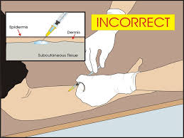 Sputum smear microscopy is inexpensive and simple, and people can be trained to do it relatively quickly and easily. Tb Skin Testing Ppt Video Online Download