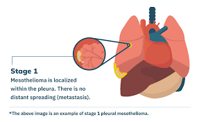 Pleural mesothelioma is the most common form the disease, accounting for more than 75% of cases. Stage 1 Mesothelioma Symptoms Treatment Prognosis