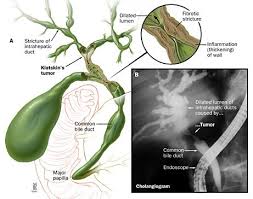 Gastroenterology And Hepatology Johns Hopkins Medicine In Baltimore Md Bile Duct Cancer Awareness Bile Duct Cancer Bile Duct
